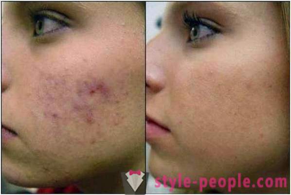 Пилинг азелаинова киселина: мнения козметолози, снимки преди и след