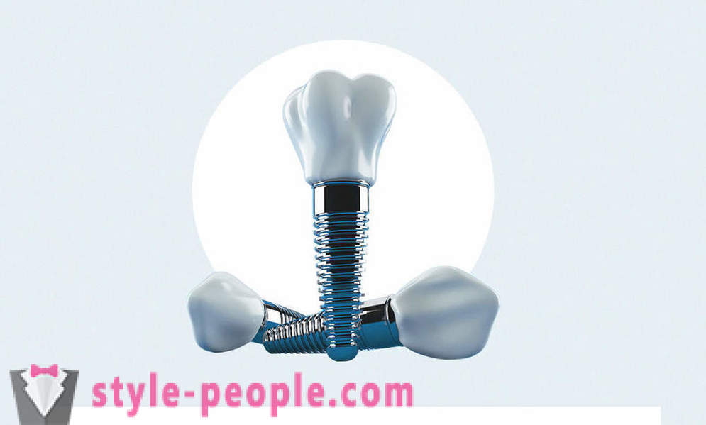 8 въпроси за зъбни импланти