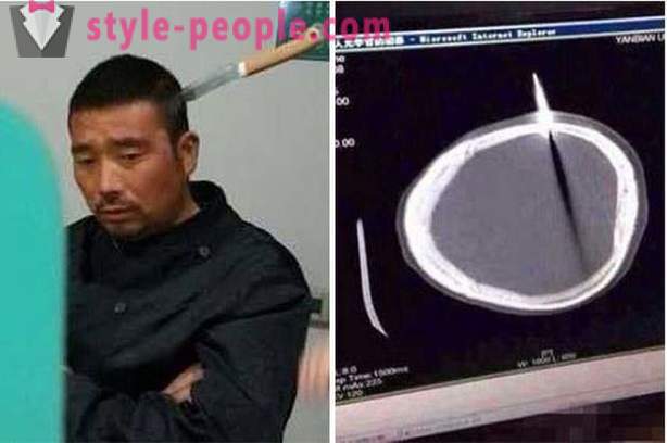 Един китайски човек с нож в главата му, той отиде на лекар