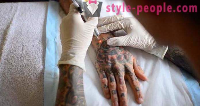 Лазерно премахване на татуировки. Прегледани на
