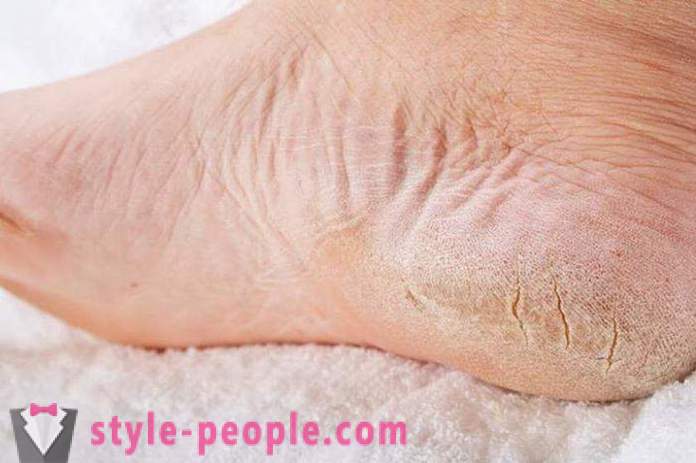 Суха кожа на краката си: Причини