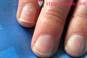 Което може да означава, бяло петно ​​на ноктите?
