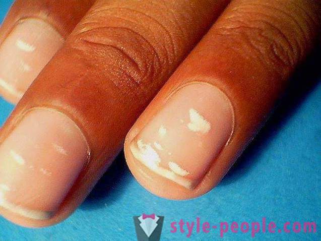 Което може да означава, бяло петно ​​на ноктите?